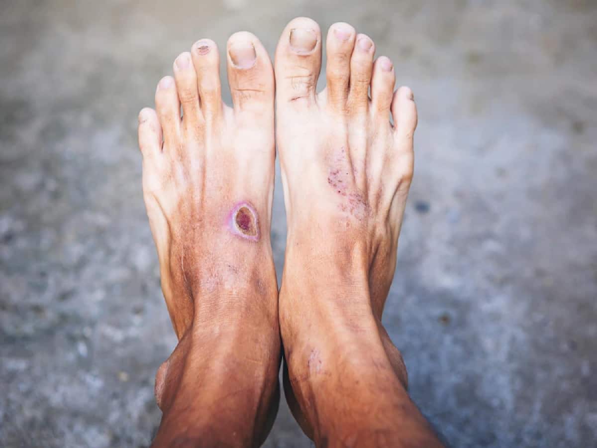 Charcot Foot Or Diabetic Foot Ulcer: Growth Factor Therapy Can Help Prevent Limb Amputation